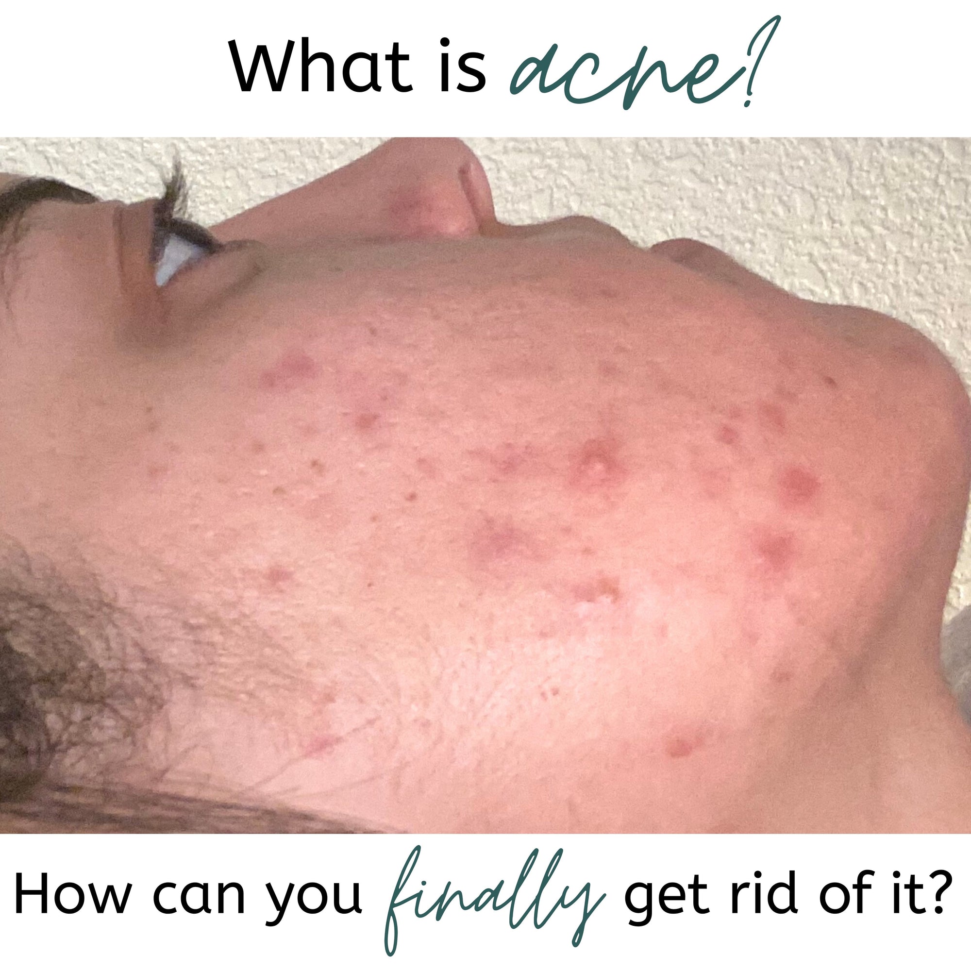 What is Acne and How Can You Finally Get Rid of It?!